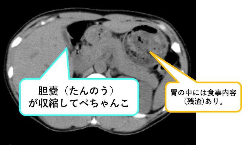 腹部のCT - その他